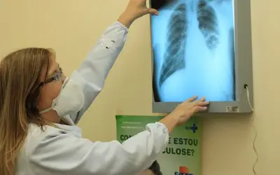 Brasil instala comitê interministerial para eliminação da tuberculose 